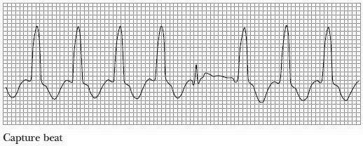 initiated impulse causes depolarization of ventricle Positive