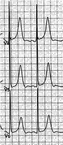 Hyperkalemia & The ECG ECG Abnormalities Prominent T waves QRS complex widening Interval prolongation (PR & QT) Dysrhythmias Bradycardia / AV block Ventricular dysrhythmias Sinoventricular rhythm