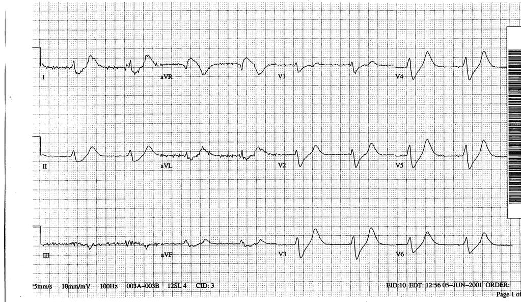 2/13/17 Widening of QRS Complex with bradycardia