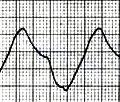 over 15 minutes with appropriate therapy, normalization of ECG 0924 0928 0933 QRS Complex Widening Stabilization / Shift / Removal Therapies Sinoventricular
