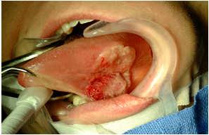 Incidence Oral Cavity Cancer Classically males over 45 years old Male : Female ratio 6:1 in 1950 2:1 in 1987 Frequency by site Lip >oral tongue >FOM >gingiva > RMT >palate Oral Cavity Cancer Risk