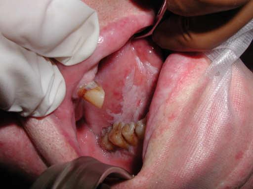 Question: What is the best adjuvant oral cancer