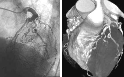 Coronary artery stenosis Contrast
