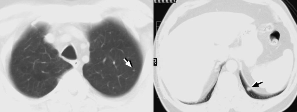 CT screening for lung cancer and followup of lung nodules Nodules as small as 2-3 mm are easily seen