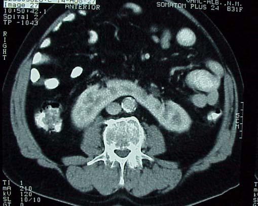 CT scans