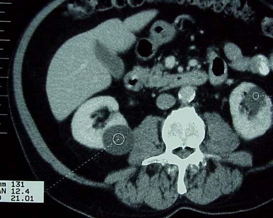 Renal cysts
