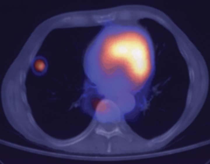 Lung metastasis from laryngeal cancer CT scan PET/ CT