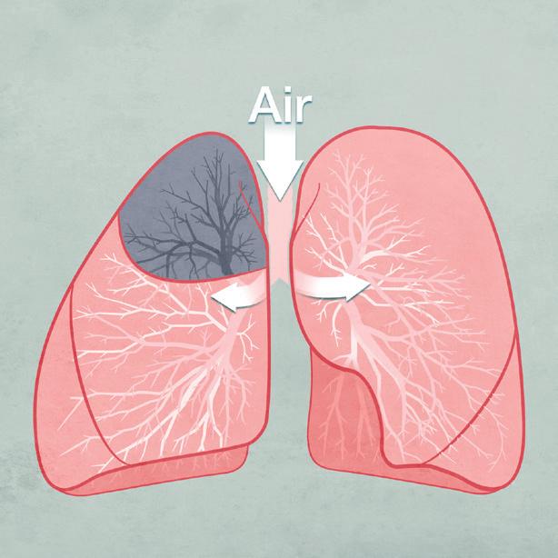 The volume of the treated part of the lung is reduced, allowing healthier parts of the lung to expand and function more normally.
