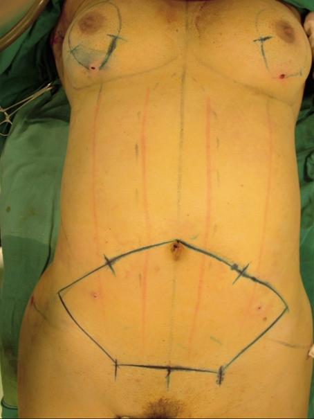 2 Lipoabdominoplasty Fig. 1. Patient in the dorsal decubitus position. Landmarks are remarked, and liposuction in upper abdomen is realized except in the area with dashed lines above the umbilicus.