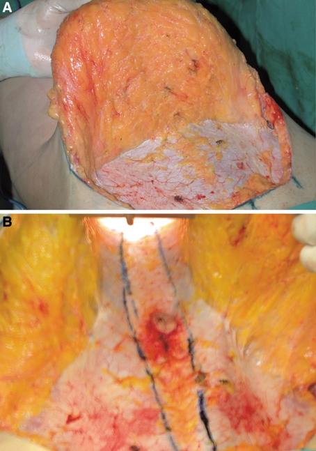 Ruth Graf et al. 3 Fig. 5. Previous demarcation of Baroudi sutures in the fascia. Upper abdomen sutures between the fat layer of the flap and the fascia underneath. Fig. 3. (A) Lower abdomen flap undermining between the rectus abdominus fascia and the fat layer, performed using traditional abdominoplasty (left).
