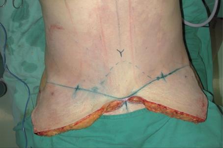 4 Lipoabdominoplasty Fig. 7. (A) Patient in the Fowler position with traction of the flap and demarcation of the area to be resected (left). (B) After resection of the flap excess (right). Fig. 9.