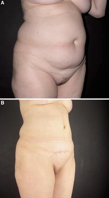 6 Lipoabdominoplasty Fig. 12. (A) Preoperative oblique view of the same patient as in Figure 11. (B) The same patient 1 year postperatively. respective myocutaneous perforators [9].