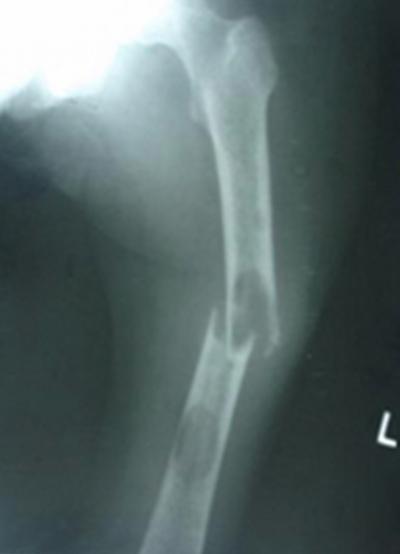 Figure 1 Figure 1: X-ray Left Femur shows a well marginated cortical lytic lesion with