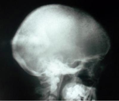 Figure 4 Figure 4: X-ray Skull (Lateral) shows diffuse trabecular resorption, giving a granular 'salt and pepper' appearance.