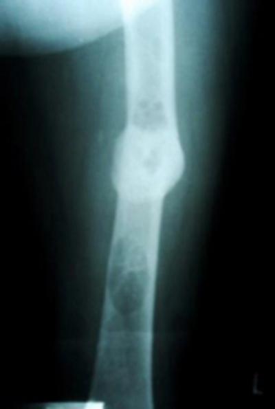 Figure 5 Figure 5: X-ray Left Femur taken nine months after fracture shows union of the fracture fragments with callus formation. Brown tumor is seen in the distal femur.