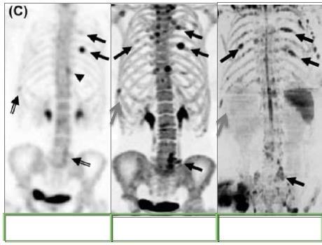 BONE METASTASES Definition low volume disease Imaging Modality Dependent Patient with prostrate cancer 1 Patient with breast cancer 2 0-4 Bone scan 4-20 18F-choline-PET >20 NaF-PET This meta-analysis
