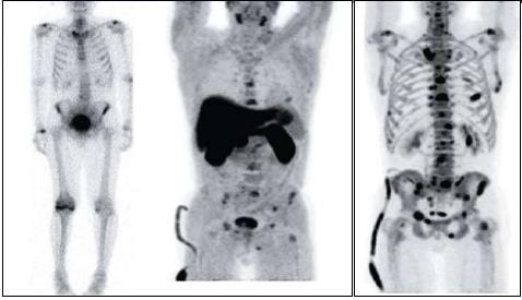 83) BS + SPECT NaF-PET WBMR_DWI BS, bone scintigraphy. 1. Kjölhede H, et al., BJU Int 2012;110:15016; 2. Jambor I, et al.