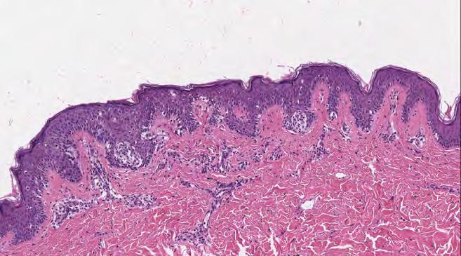 melanocytic proliferation Bulges