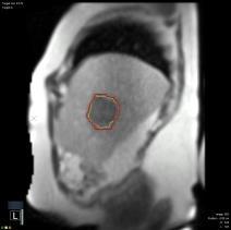 Anterior posterior 8/1/2017 Gadoxetate for Stereotactic Ablative Liver Metastasis Radiation MRI Tracking During Treatment Superior Radiation is only on when tumor