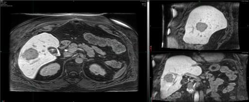 Diagnostic T1 weighted Gadoxetate