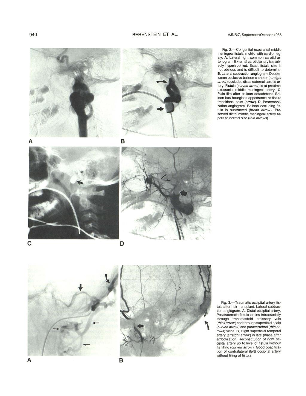 940 ERENSTEIN ET L. JNR:7, September/October 1986 Fig. 2.-Congenital exocranial middle meningeal fistula in child with cardiomegaly., Lateral right common carotid arteriogram.