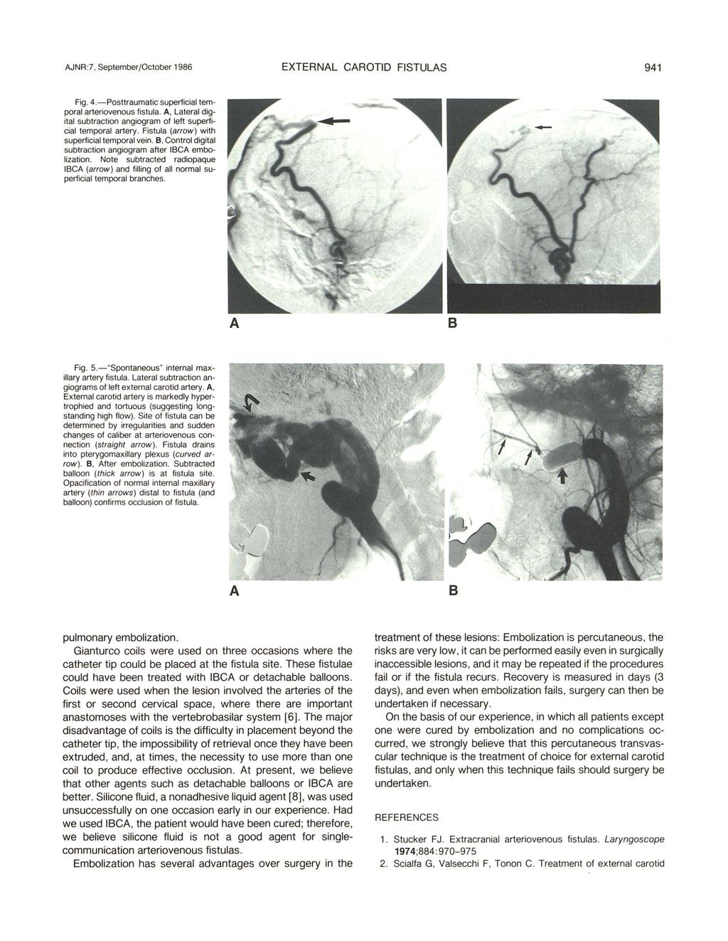 JNR :7, September/October 1986 EXTERNL CROTID FISTULS 941 Fig. 4.-Posttraumatic superficial temporal arteriovenous fistula., Lateral digital subtraction angiogram of left superficial temporal artery.