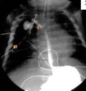 Anastomotic leak Early complication occurring in 17% of patients Typically will resolve spontaneously without oral feeds or with pleural drainage Case reports of glycopyrolate and atropine