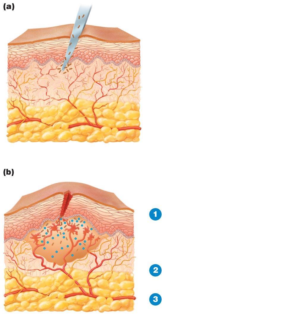 Figure 16.9a-b The process of inflammation.