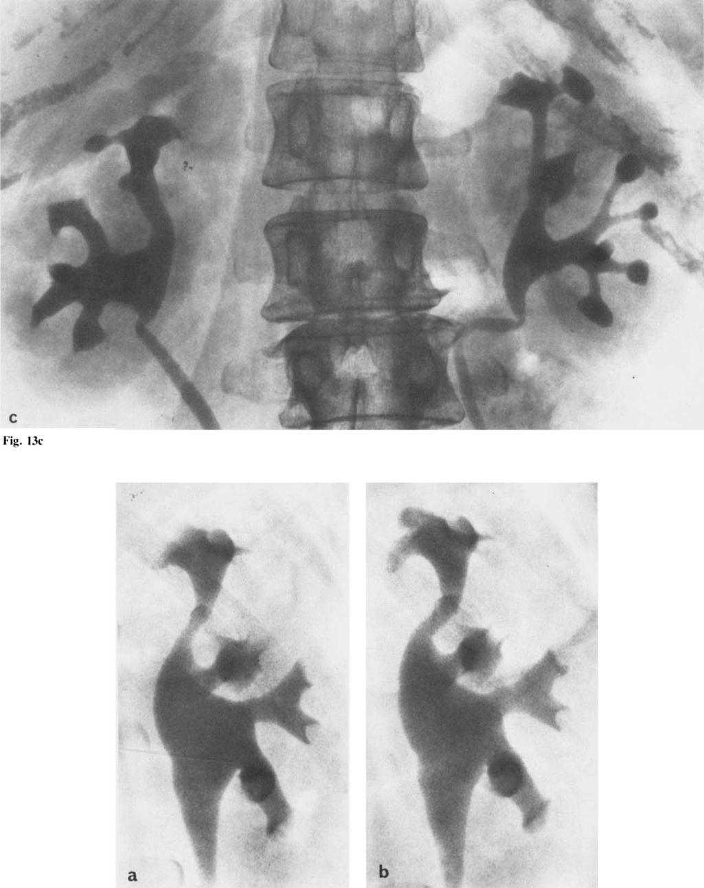 104 Lindvall -4 a b Fig. 14. Urographicfindings in woman with analgesic abuse: a) Norma/findings initially. b) Three years later.