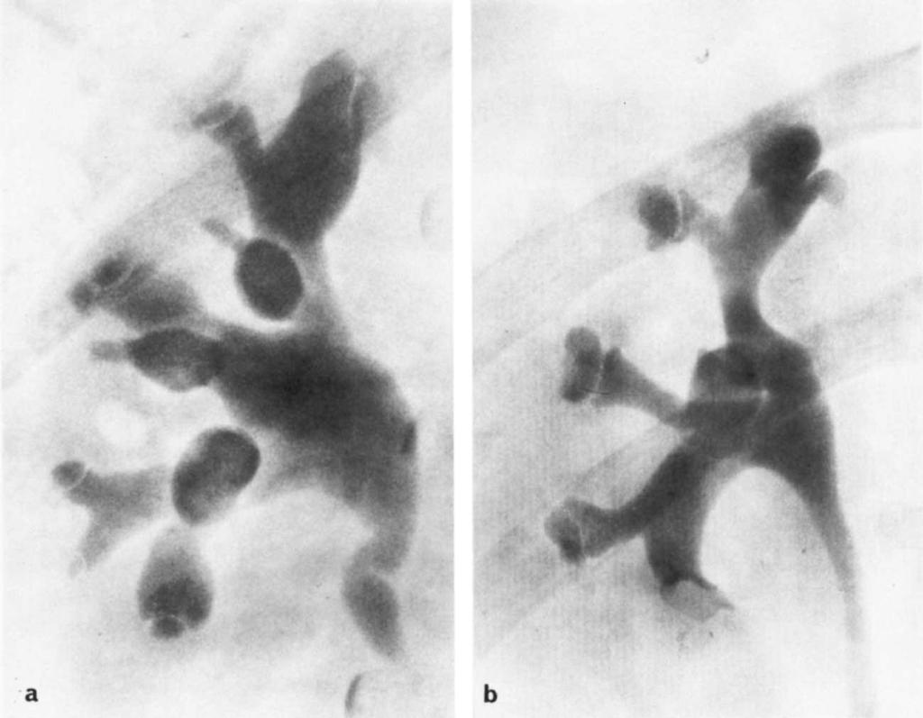 b) Woman with diabetes and recurrent urinary tract infection. (Reprinted with permission from Acta Radiologica [61.) they have a stroma of necrotic papillary tissue.