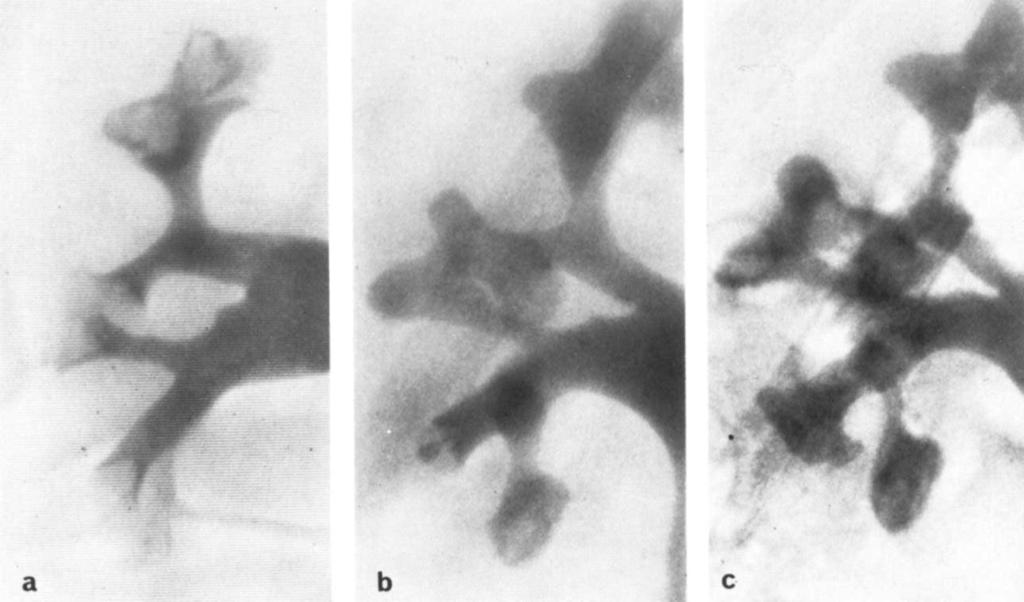 Renal papillary necrosis: Radiologic changes 97 C Fig. 4. Urographic findings in woman with analgesic abuse: a) Ring-shadows in uppermost papillae.