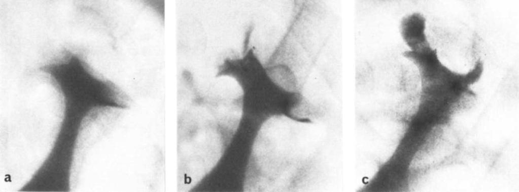 There is complete detachment of uppermost papilla, showing typical triangular ring-shadow. (Reprinted with permission from Acta Radiologica [61.) Fig. 7.