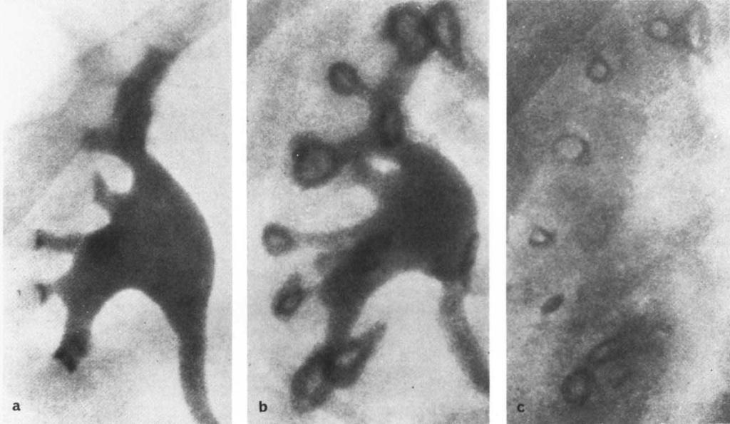Renal papillary necrosis: Radiologic changes 99 b Fig. 8. Urographic findings in man with analgesic abuse: a) Normal findings initially. b) Contrast density slightly reduced. Kidney size is normal.