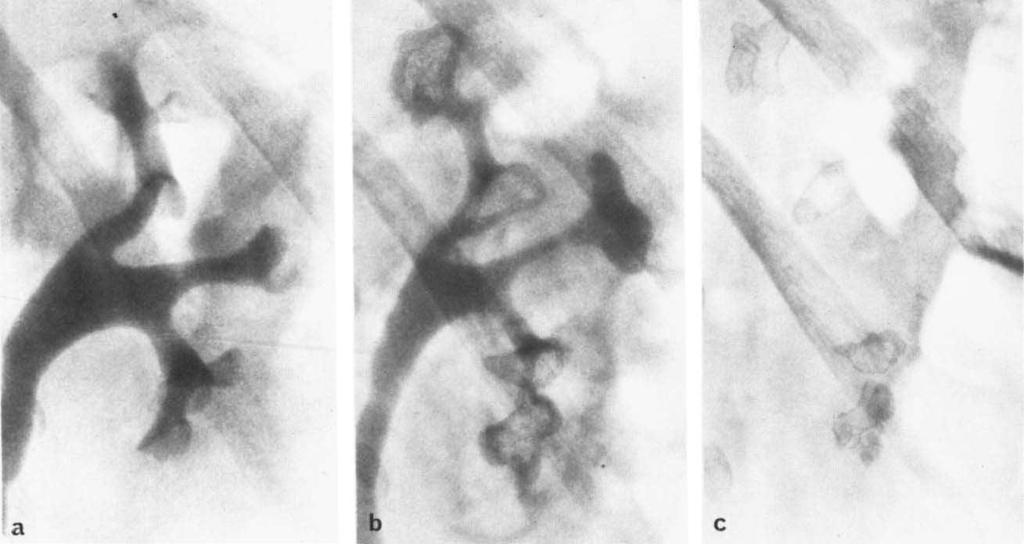 9. Urographic findings in woman with analgesic abase: a) Incipient detachment in central papilla. b) One year later. Note the typical irregular TPN ring-shadows and one empty TPN cavity.