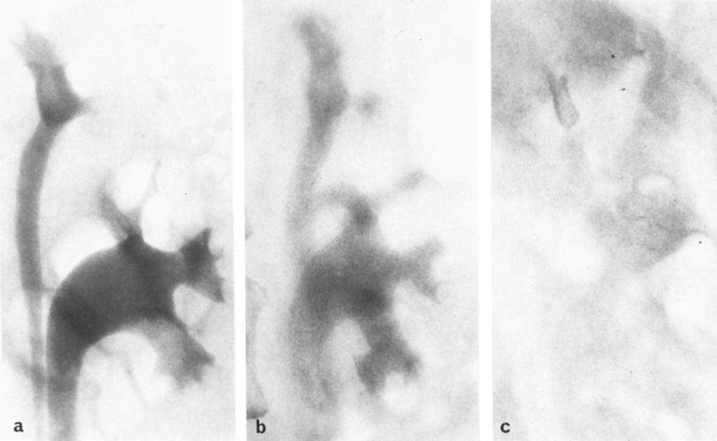 Renal papillary necrosis: Radiologic changes 101 Fig. 11. Urographic findings in woman with analgesic abuse: a) Normal findings initially. b) 11 months later. Contrast density is appreciably reduced.