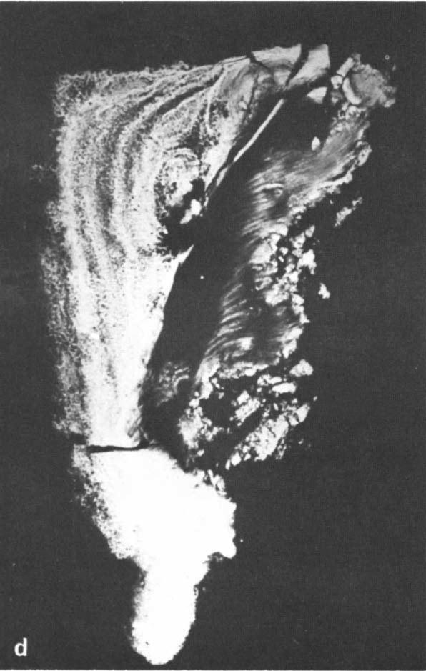 d)microradiography showing the concretion to have been built on a not detached necrotic papilla with calcf1cations. (Reprinted with permission from Acta Radiologica [6].