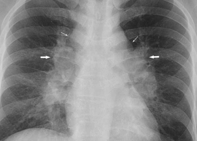 Park et al. pulmonary infiltrations. ilateral hilar lymphadenopathy is the most common radiological finding.