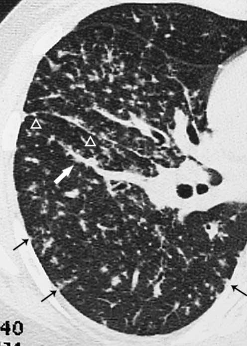 Typical and typical Manifestations of Intrathoracic Sarcoidosis however, sarcoid granulomas can also progress to fibrosis (2-4).