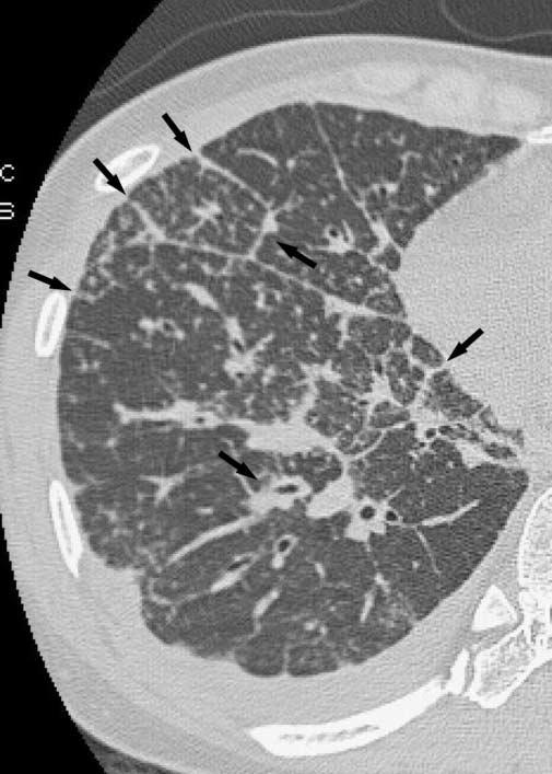 Fig. 4. Imaging findings for interstitial thickening in sarcoidosis are presented.