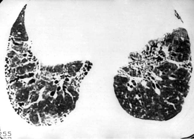 Progressive fibrosis leads to masses of peribronchovascular fibrous tissue with conglomeration of parahilar bronchi and vessels that is typically most marked in the upper lobes (Fig. 5).