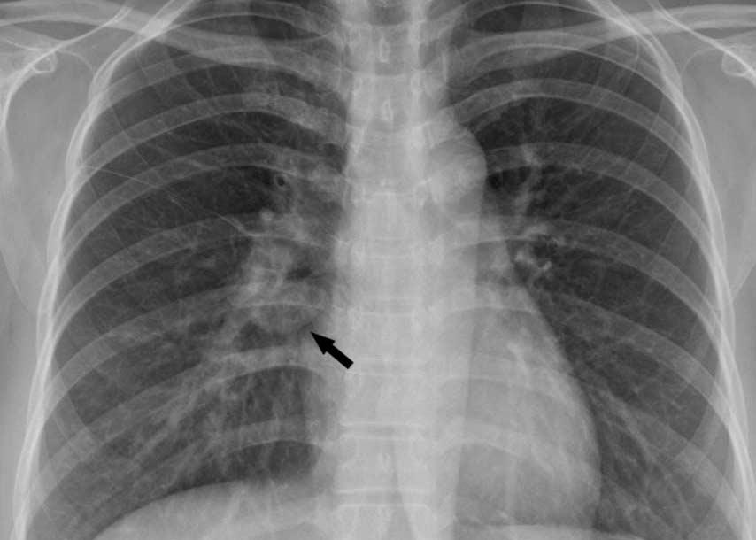 Typical and typical Manifestations of Intrathoracic Sarcoidosis Fig. 7.