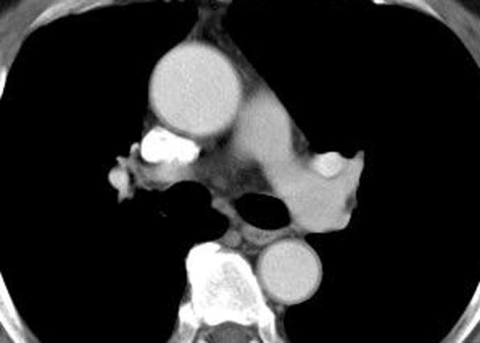 Mediastinal lymphadenopathy without hilar lymphadenopathy is even less common (Fig. 8).