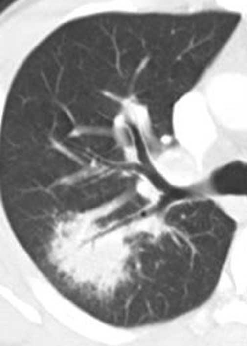 to either ischemic necrosis within conglomerated areas of sarcoid granulomas or extrusion of ischemic hyaline fibrous tissue (Fig. 10). To Fig. 9.