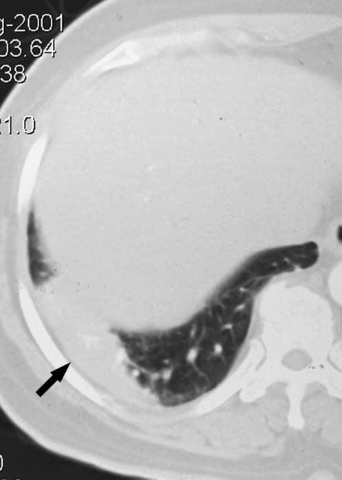High-resolution CT scan shows ill-defined nodular opacity resulting from confluence of interstitial granulomas (arrow).