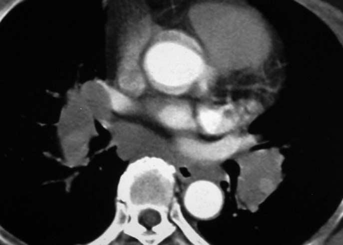 Ground glass opacity in sarcoidosis is demonstrated. xial CT scan with lung window setting shows localized area of ground glass opacity at posterior segment of right upper lobe.