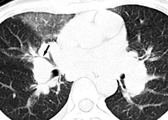 Park et al. Fig. 15. Imaging findings for bronchial narrowing in sarcoidosis are presented.