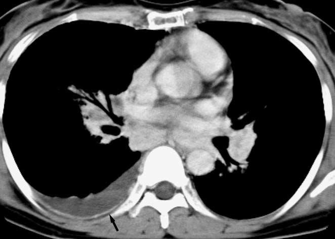 ssociated ground glass opacity in right upper lobe is seen. Fig. 16. Pleural involvement in sarcoidosis is demonstrated.