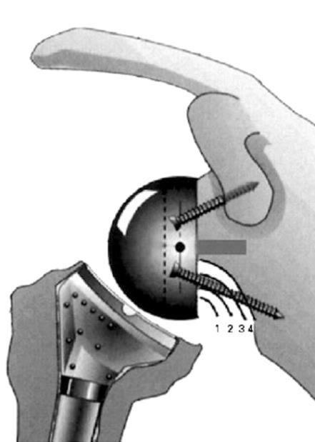 Neer Award 2005: The Grammont reverse shoulder prosthesis: results in cuff tear arthritis, fracture