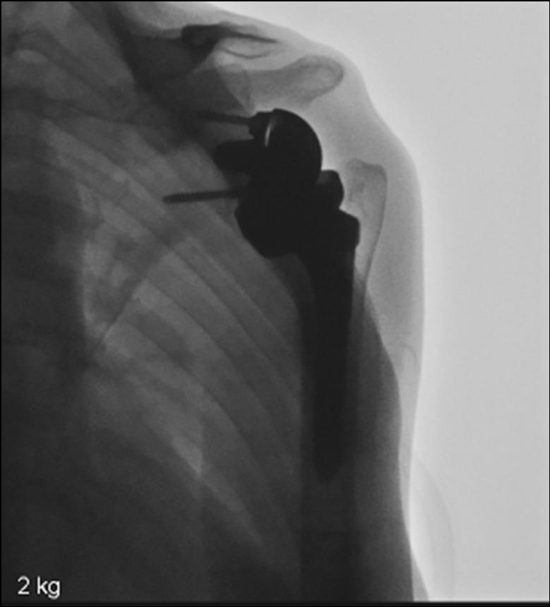 Scapular Notching Inversed Prosthesis associated with: - too high position of glenosphere - superior tilting mostly posteroinferior location probably caused by abduction/elevation and external