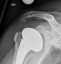 Glenohumeral Instability Second leading cause of prosthesis dysfunction Inferior: Causes: -